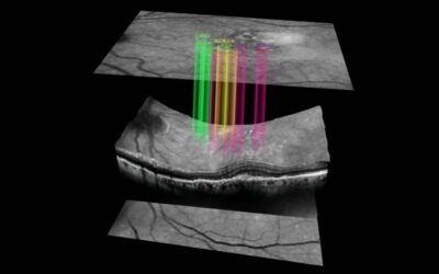 Un nuevo test pionero puede predecir la DMAE húmeda tres años antes de que aparezcan los síntomas