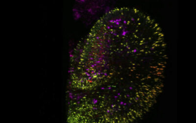 Investigadores utilizan células de pacientes para probar terapia génica para una forma de Amaurosis Congénita de Leber