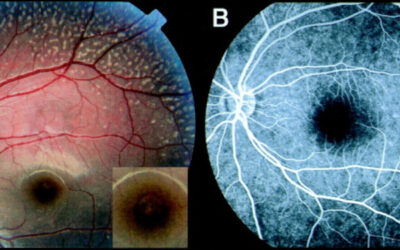 Stargardt, Fundus albipunctatus y Optica adaptativa