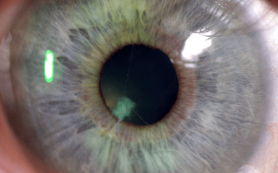 Asociación entre discapacidad visual y depresión en pacientes que acuden a consultas oftalmológicas