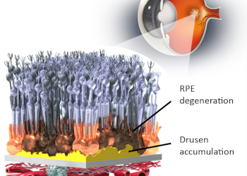 Datos clínicos de OpRegen demuestran mejoras en pacientes con Atrofia Geográfica DMAE