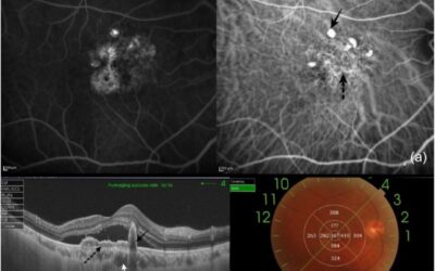 Vasculopatía coroidea polipoidea: actualización clínica
