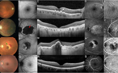Se acelera la investigación en terapia génica para las enfermedades de la retina