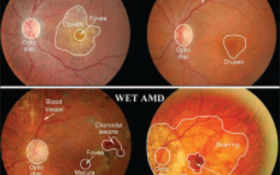 Epidemiología y factores de riesgo de la DMAE