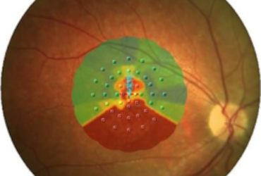 Locus retiniano preferido