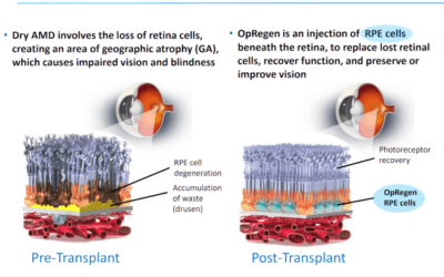 Cuarto caso de restauración del tejido de la retina en pacientes con DMAE seca con OpRegen