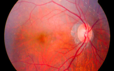 Entender lo que supone la retinosis pigmentaria ligada al cromosoma X (XLRP)