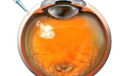 Resultados a largo plazo de la terapia anti-VEGF para DMAE