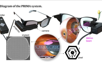 Primera paciente con DMAE que recibe el implante biónico Pixium que le ayuda a recuperar parcialmente la visión