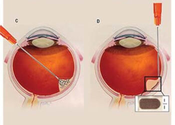 Terapia con células madre para la Dmae no neovascular