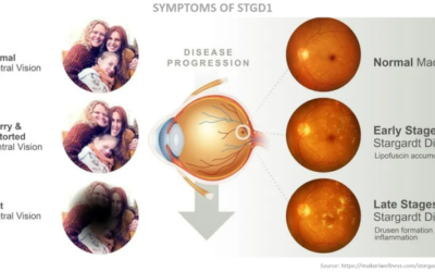 Ensayo clínico con Tinlarebant (LBS-008) para adolescentes con Stargardt 1 (STGD1)