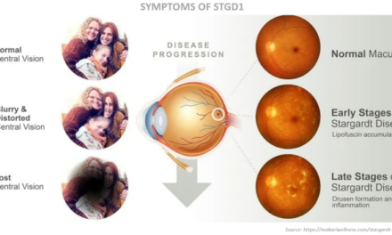 Ensayo clínico con Tinlarebant (LBS-008) para adolescentes con Stargardt 1 (STGD1)