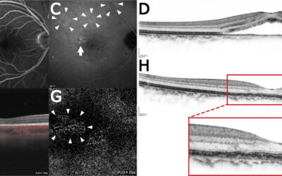 Membranas neovasculares, coriorretinopatía serosa central, vasculopatía coroidea polipoidea y genómica