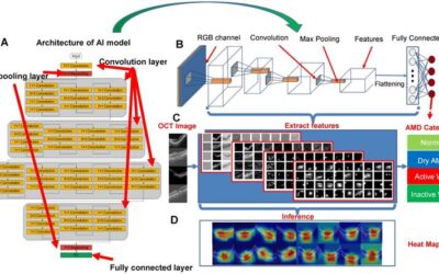 Inteligencia Artificial, cambios en la retina y diagnóstico y tratamiento de la DMAE seca avanzada