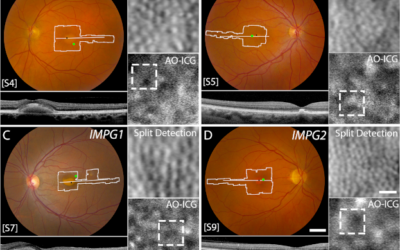 Una nueva técnica de imagen revela detalles imperceptibles sobre la distrofia macular viteliforme (BEST1, PRPH2, IMPG1, IMPG2)