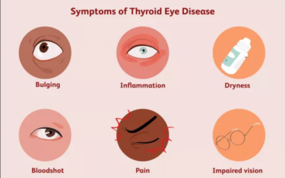 Enfermedad Ocular Tiroidea – Oftalmopatía de Graves – EOT