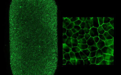 Primer paciente USA recibe terapia con células madre autólogas para tratar la DMAE seca