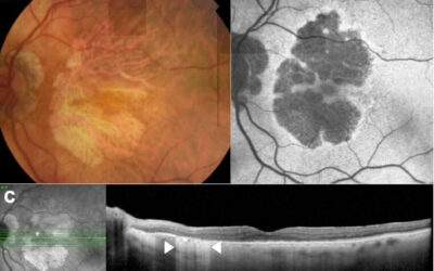 El desarrollo de fármacos para la atrofia geográfica afronta su futuro