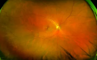 Estudio fase 2a de RG6501 (OpRegen) en pacientes con atrofia geográfica (DMAE)