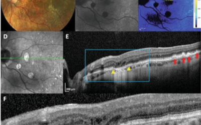 Dos enfermedades oculares diferentes pueden causar la DMAE