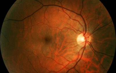 Opus Genetics adquiere los derechos de dos programas de terapia génica para mutaciones BEST1 y RHO-adRP