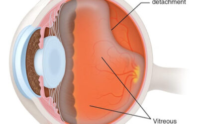 Desprendimiento de vítreo