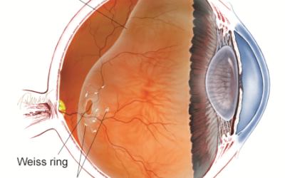 Qué es la vitrectomía