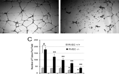 La píldora oral APX3330 de Ocuphire Pharma puede prevenir el avance de la Retinopatía Diabética