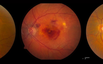 La FDA aprueba los primeros medicamentos para tratar la forma seca de la DMAE