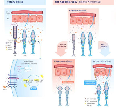SparingVision culmina la fase final de escalado de dosis en el ensayo PRODYGY con SPVN06 para retinosis pigmentaria