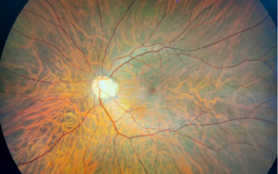 Ascidian realizará un ensayo clínico para Stargardt mediante terapia de edición de ARN