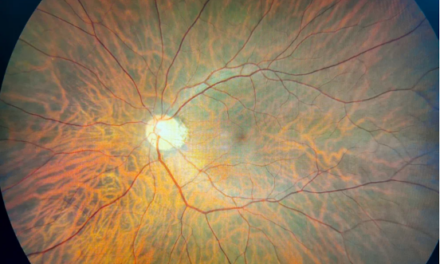 Ascidian realizará un ensayo clínico para Stargardt mediante terapia de edición de ARN