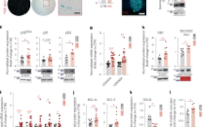 Estrategia terapéutica contra la senescencia celular en el edema macular diabético
