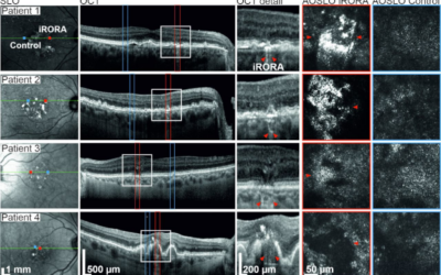 Detección temprana de la pérdida de visión en la degeneración macular relacionada con la edad (DMAE)