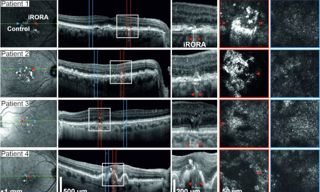 Detección temprana de la pérdida de visión en la degeneración macular relacionada con la edad (DMAE)