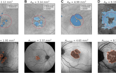 Inteligencia Artificial para optimizar el reclutamiento en Ensayos Clínicos sobre Degeneración Macular Relacionada con la Edad (DMAE)