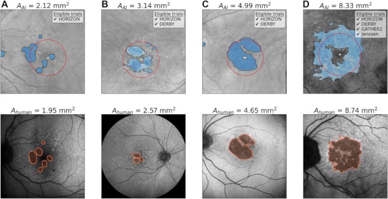 Inteligencia Artificial para optimizar el reclutamiento en Ensayos Clínicos sobre Degeneración Macular Relacionada con la Edad (DMAE)