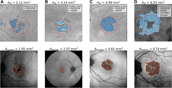 Figura 4: Ejemplos de la segmentación por IA de OCT y la segmentación clínica de FAF. Cada subtrama contiene la imagen OCT en la cara con la segmentación de IA (arriba) y la imagen FAF asociada del mismo ojo con la segmentación del evaluador R.C (abajo). La ubicación de la fóvea determinada por IA (más blanco) y un círculo de 1500 μm centrado en la fóvea (círculo rojo) están indicados. Las estimaciones de área de AG de IA y humanos promediadas también se indican, así como los ensayos clínicos para los cuales cada individuo es elegible basado en los resultados de IA (considerando las salidas para ambos ojos cuando sea necesario). (a) Este paciente es únicamente elegible para HORIZON ya que el AAI está por debajo del límite inferior para los otros ensayos (2.5 mm²). Los pacientes en (b) y (c) tienen AG central y no involucran la fóvea, pero la CNV en sus ojos compañeros los excluye de los ensayos GATHER2 y Janssen. El paciente en (d) fue determinado por la IA como apto para los criterios de imagen de todos los ensayos.