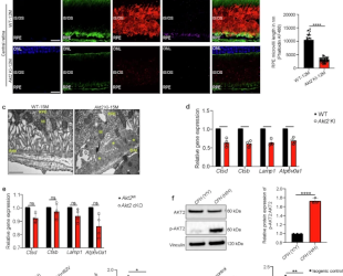 Formación de drusas. Un estudio revela la patología celular de la DMAE seca (Atrofia geográfica)
