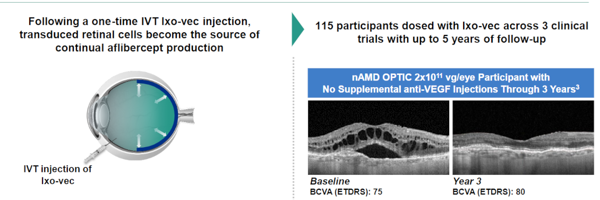 La terapia génica Ixo-vec reduce el número de inyecciones anti-VEGF en pacientes con DMAE neovascular