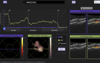 Un escáner ocular con IA optimiza el cuidado de pacientes con DMAE desde casa