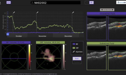 Un escáner ocular con IA optimiza el cuidado de pacientes con DMAE desde casa