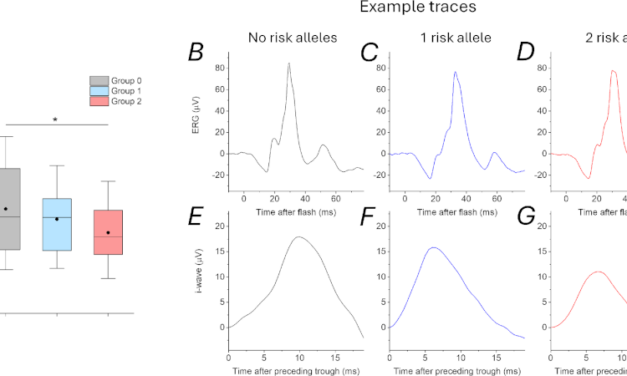 La onda i se vincula con una variante genética asociada al riesgo de miopía