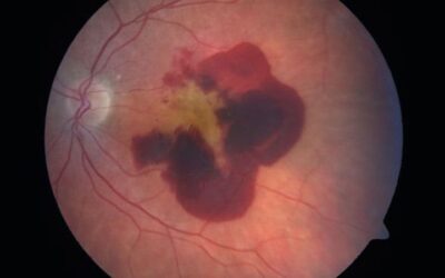 Por qué algunos pacientes no responden a los tratamientos anti-VEGF para la DMAE