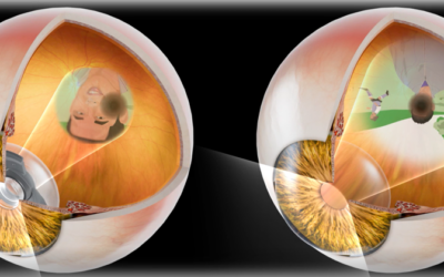 Resultados positivos a 6 meses sobre la eficacia visual y la seguridad del SING IMT®
