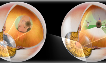 Resultados positivos a 6 meses sobre la eficacia visual y la seguridad del SING IMT®