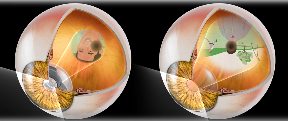 Resultados positivos a 6 meses sobre la eficacia visual y la seguridad del SING IMT®