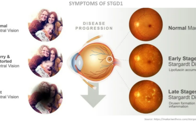 Belite Bio presenta análisis intermedio del ensayo fase 3 DRAGON sobre Tinlarebant para Stargardt
