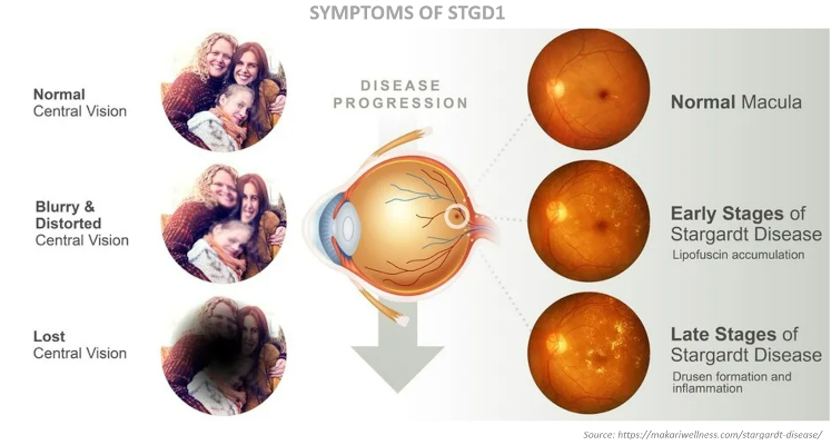 Belite Bio presenta análisis intermedio del ensayo fase 3 DRAGON sobre Tinlarebant para Stargardt