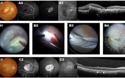 La eliminación segura de vasos sanguíneos anormales es clave para el éxito del trasplante celular en la DMAE húmeda